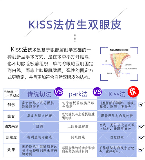kiss法双眼皮.jpg